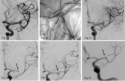 Flow diversion for unruptured MCA bifurcation aneurysms: comparison of p64 classic, p64 MW HPC, and p48 MW HPC flow diverter stents